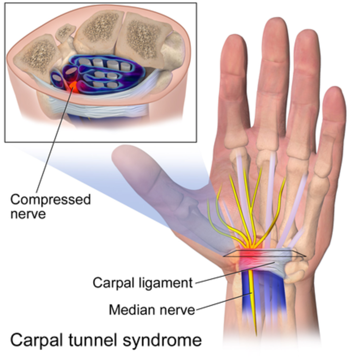 facts-concerning-carpal-tunnel-syndrome