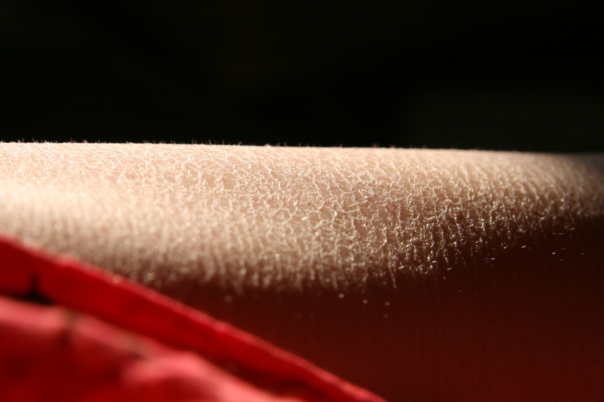 Dry skin is often itchy, but it is usually only a temporary discomfort.