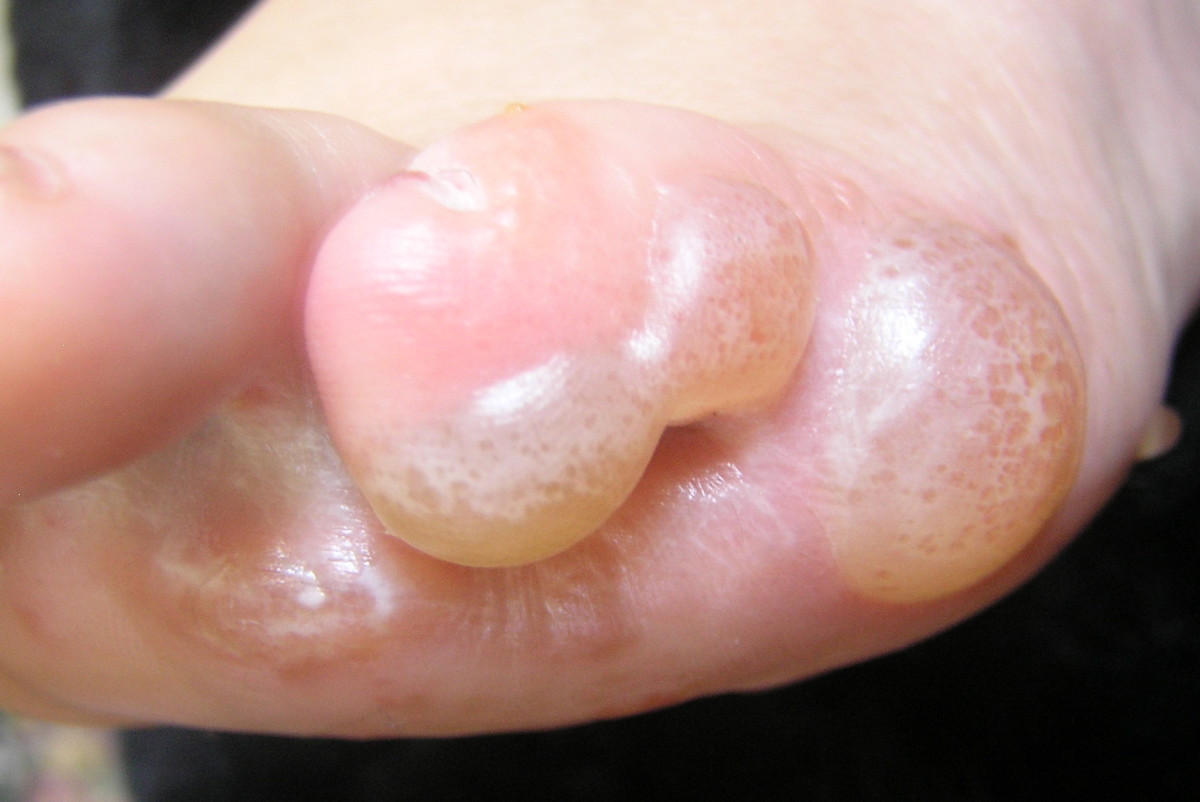 A case of complex eczema