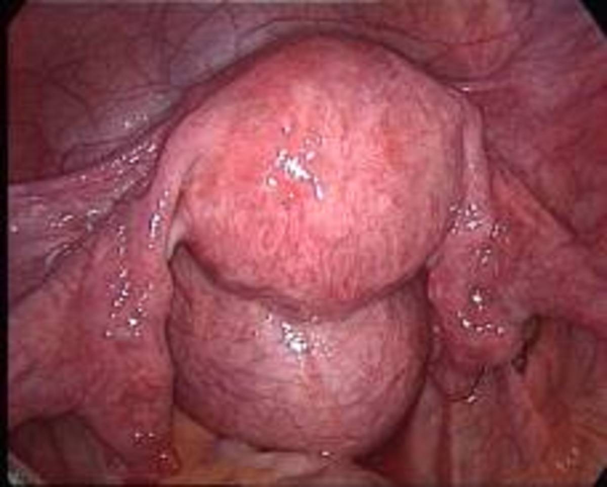 Uterus with Myoma
