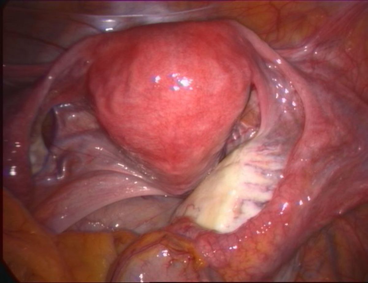 Normal Uterus