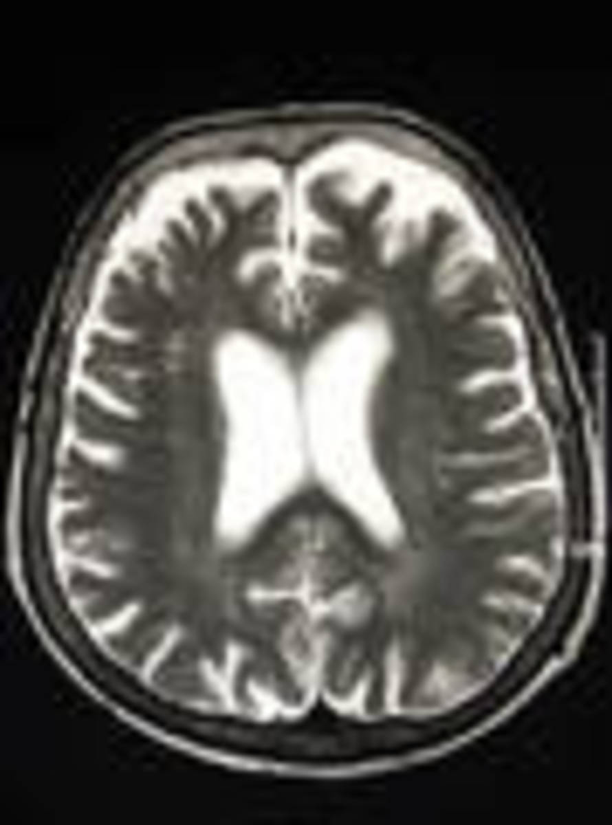 Magnetic Resonance (MR) scan of the brain
