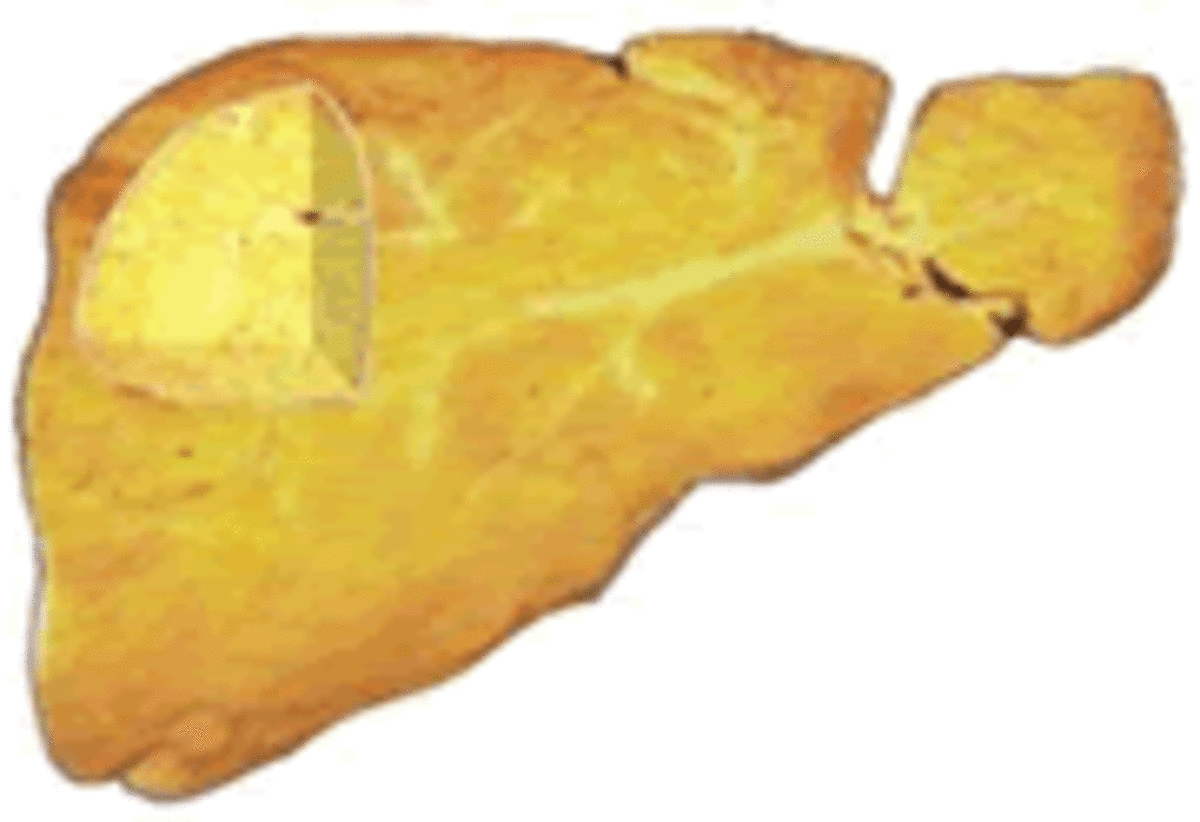 Severe Fatty Liver  