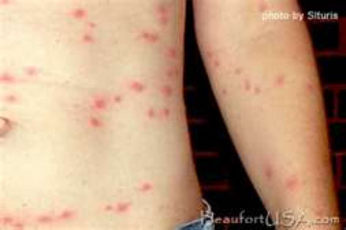 chiggers-fun-yet-horrible-facts-about-this-itchy-pest-of-summer