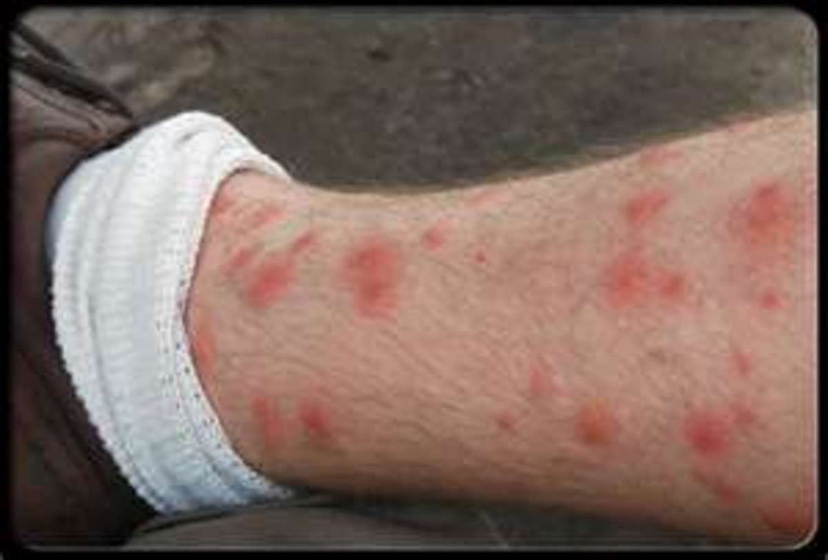 chiggers-fun-yet-horrible-facts-about-this-itchy-pest-of-summer