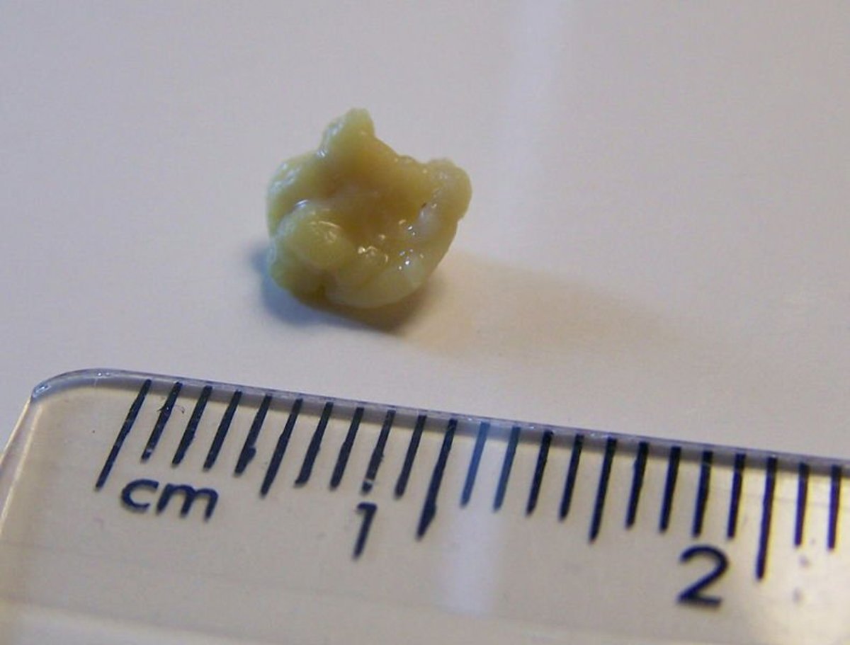 A tonsil stone!