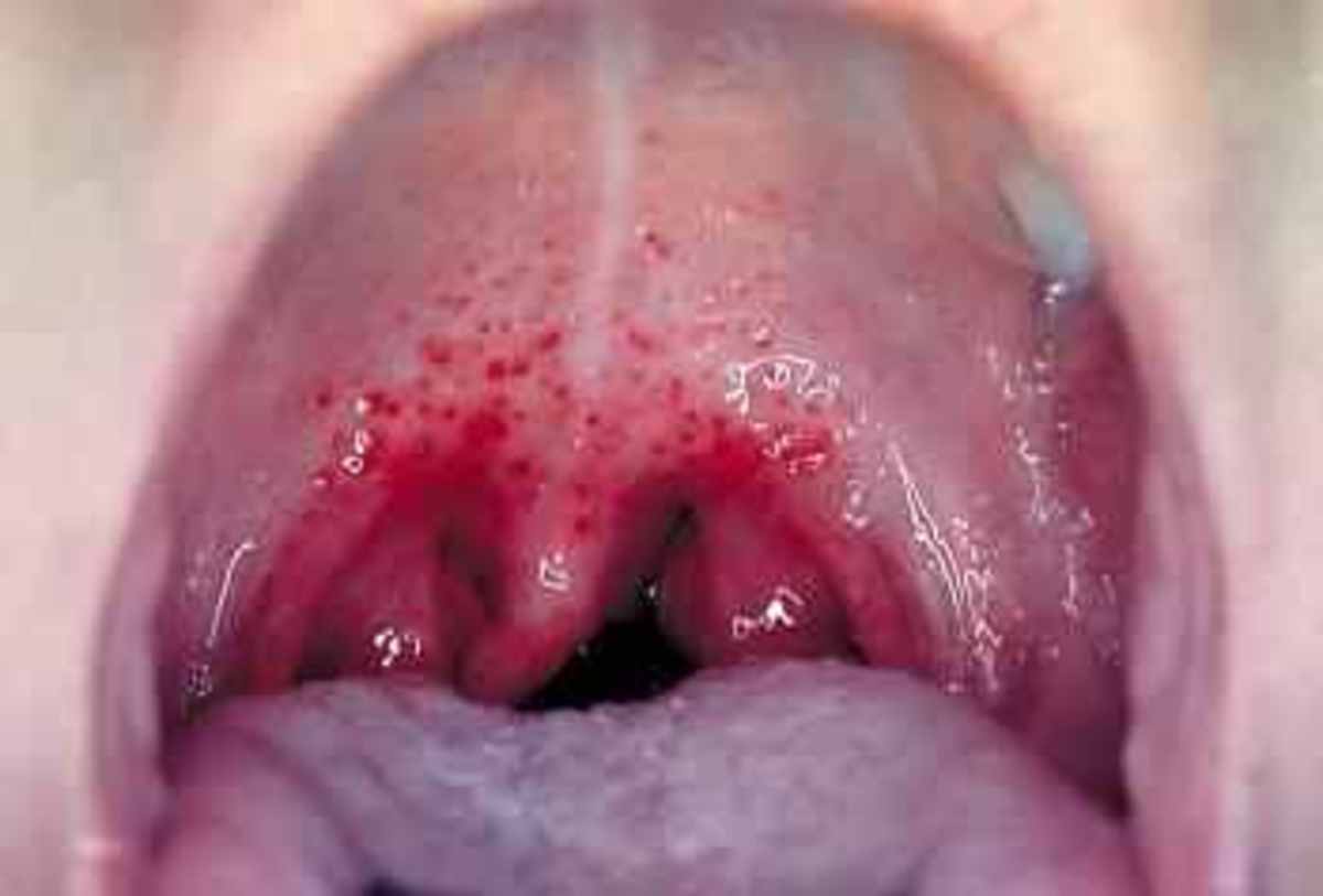 teenagers-stds-sexually-tranmitted-diseases-graphic-images-cures-effects