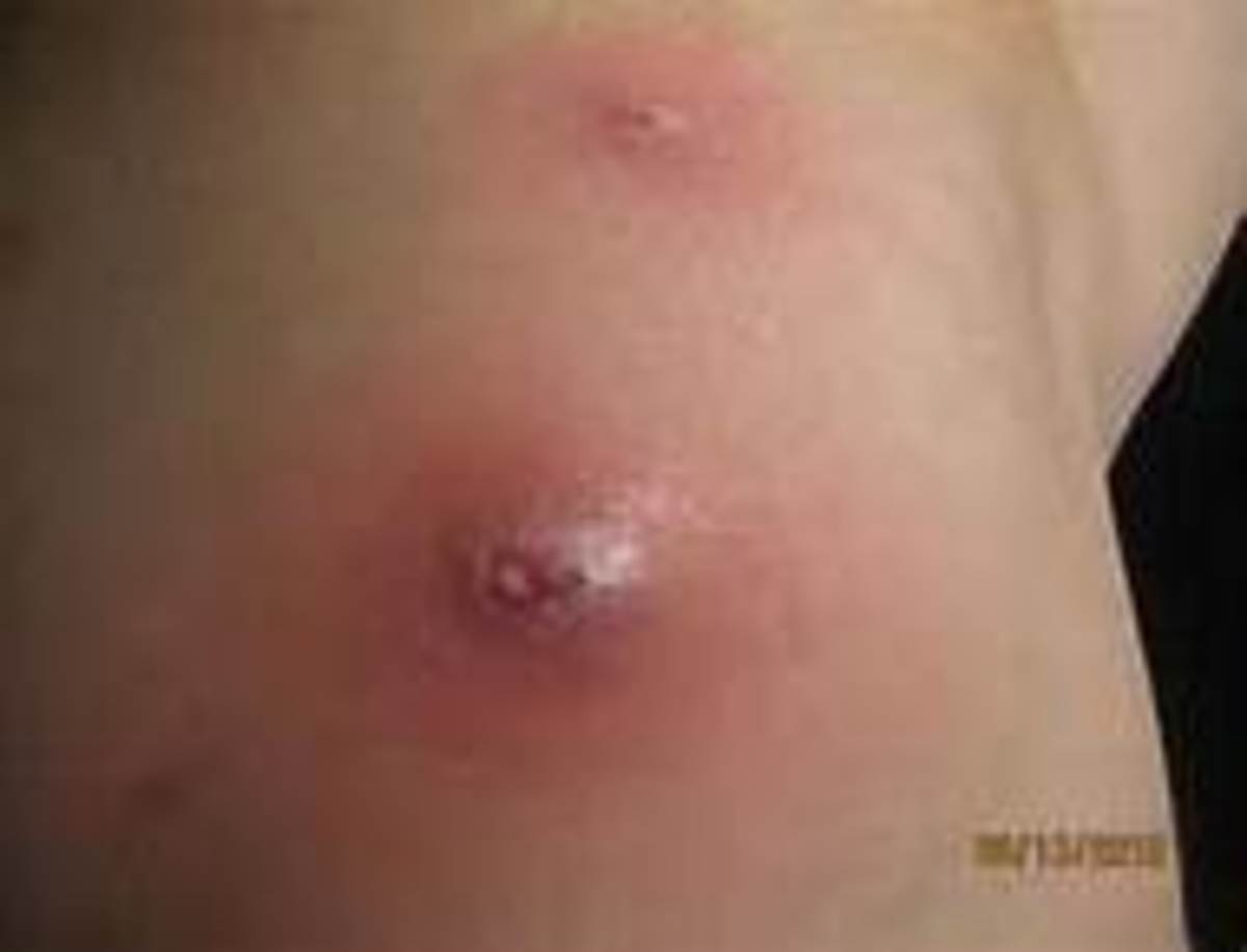 MRSA skin infection forming a boil