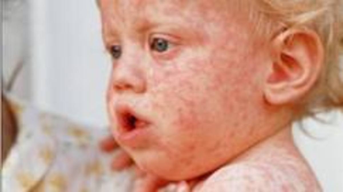 Rubella or German Measles - Symptoms Complications and how to prevent It.
