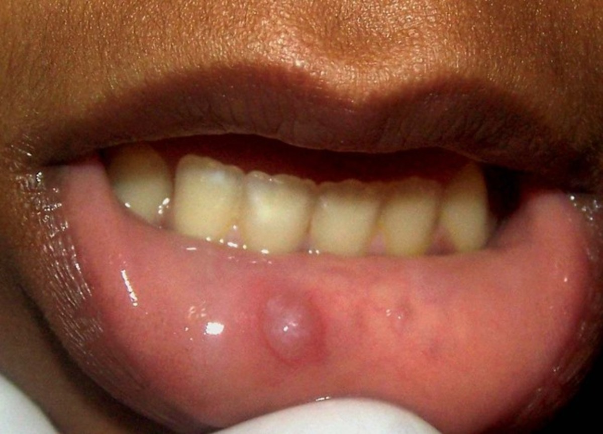 Pictures, Causes, Symptoms & Treatment of Oral Mucocele