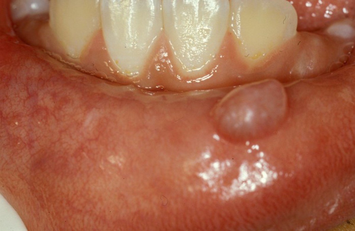 oral-mucocele