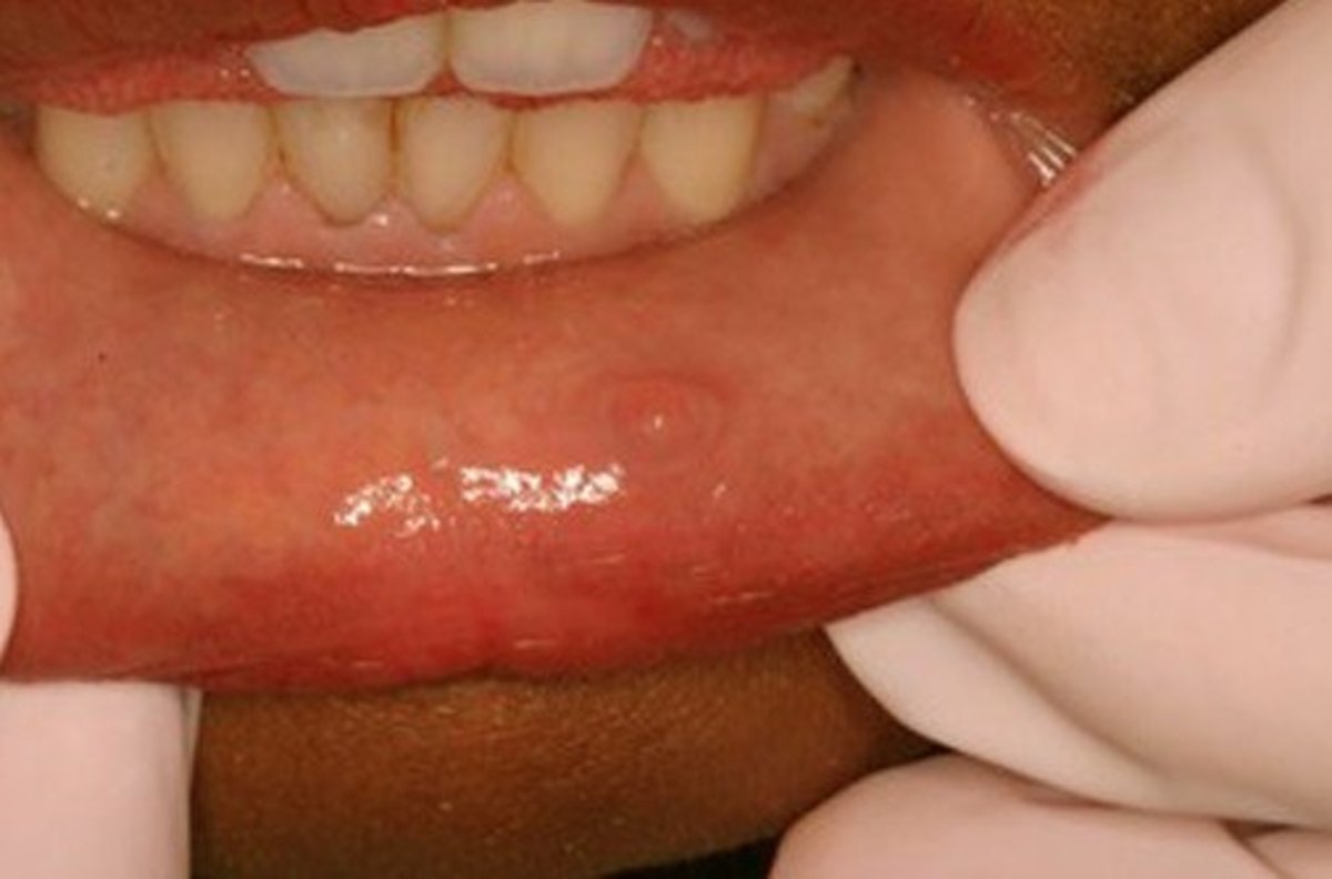 Pictures Causes Symptoms Treatment Of Oral Mucocele HubPages