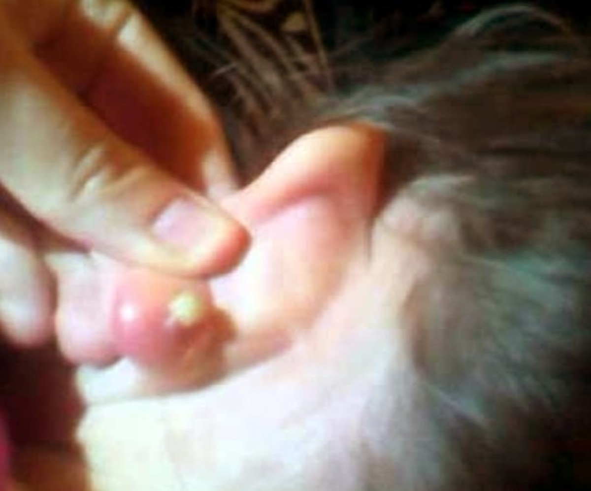 pimple-in-ear