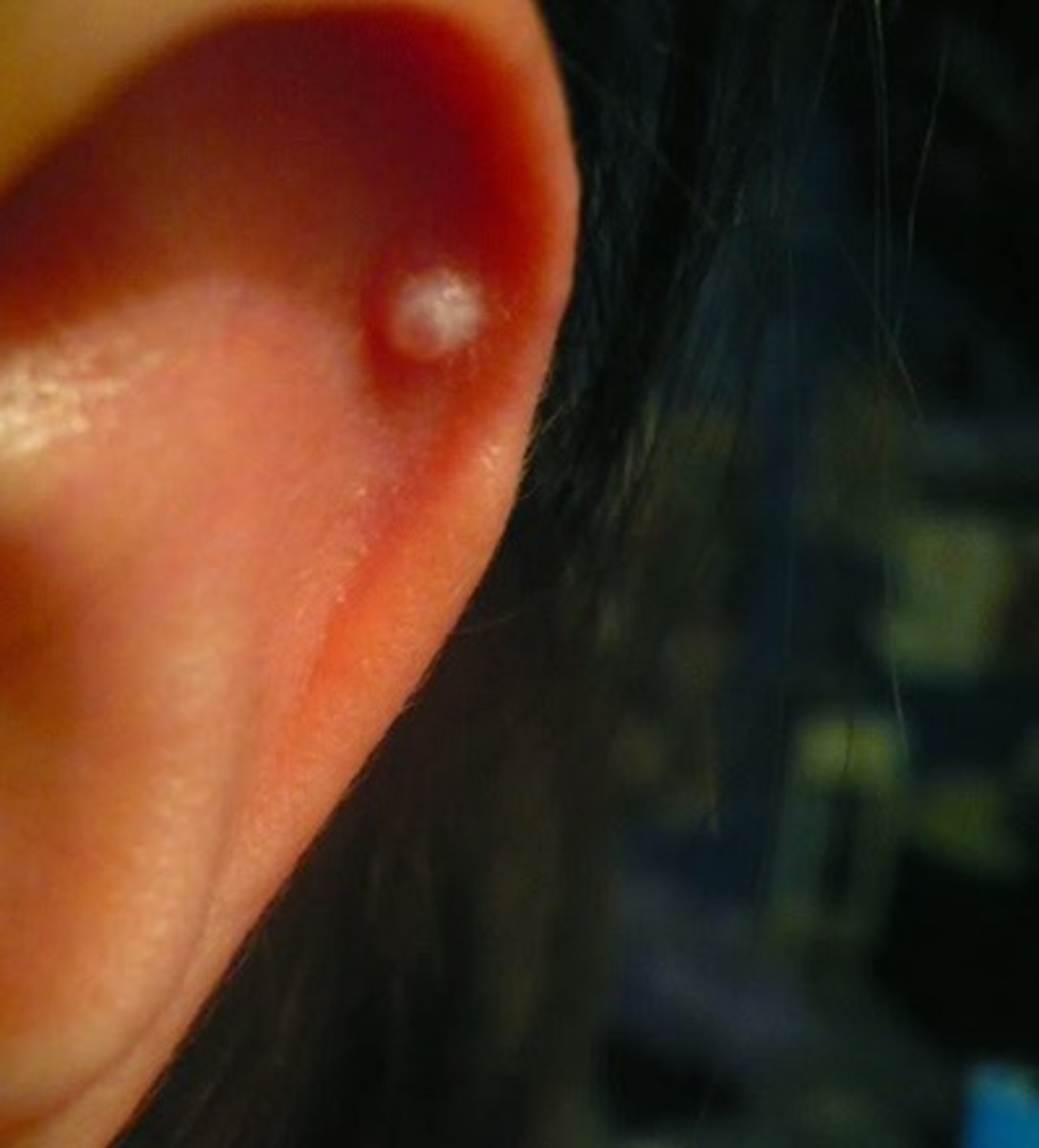 Causes, Treatment, and Pictures of Pimples in the Ear -