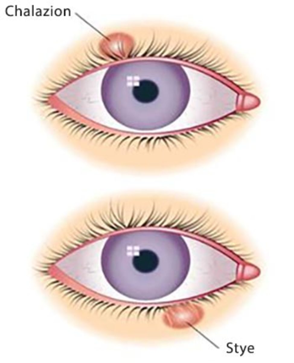 Chalazion Vs Stye What S The Difference HCZUN