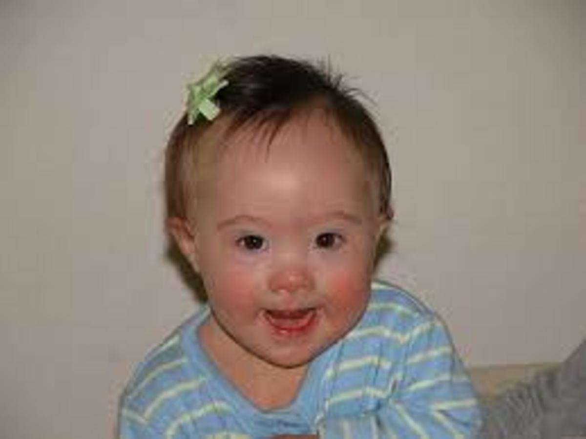 A baby girl with Down's Syndrome
