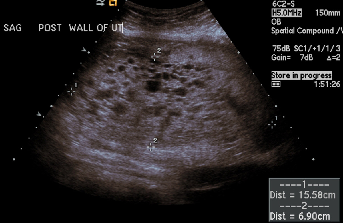USG image of complete molar pregnancy
