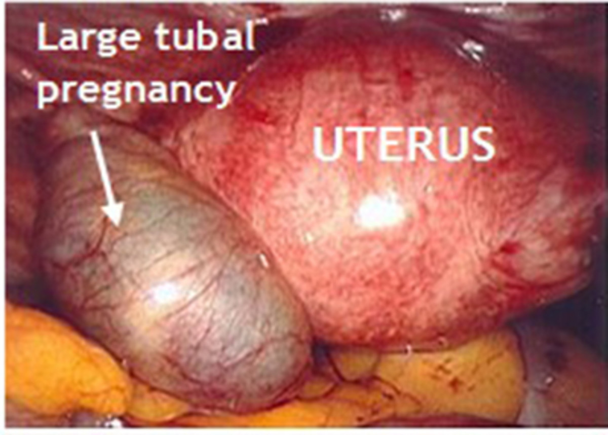 Ectopic pregnancy caused the fallopian tube to swell