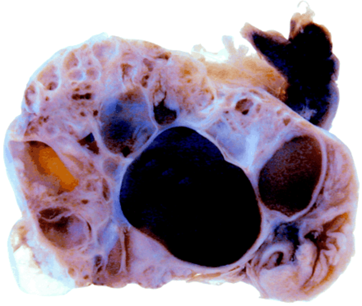 Polycystic ovary. Cysts are only small holes beyond the first layer of ovary.