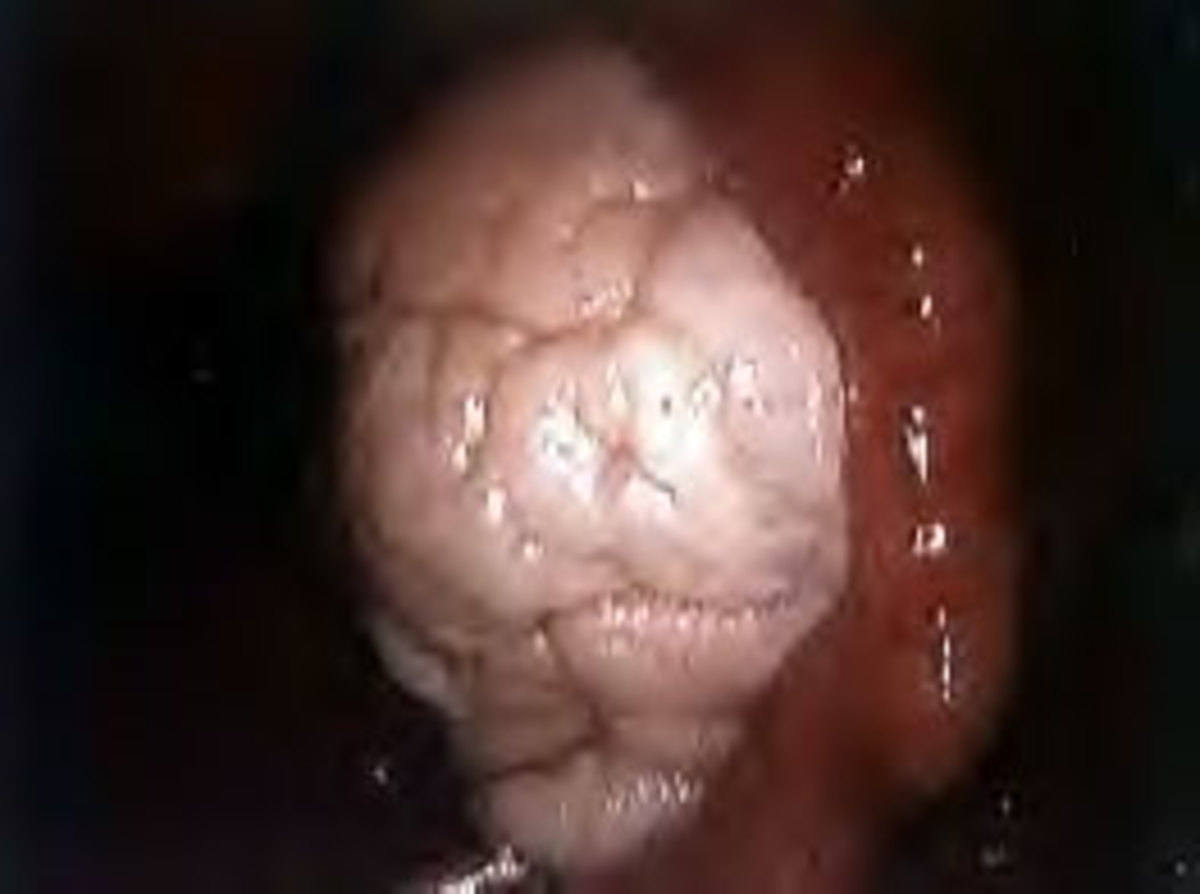 Normal ovary with Fallopian tube on the right side. 