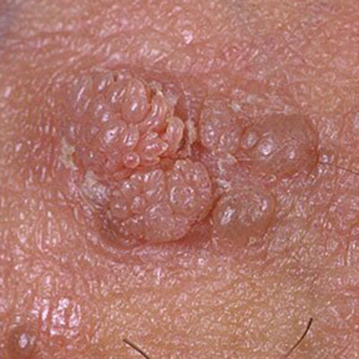There are many images on the web that demonstrate the seriousness of this disease.