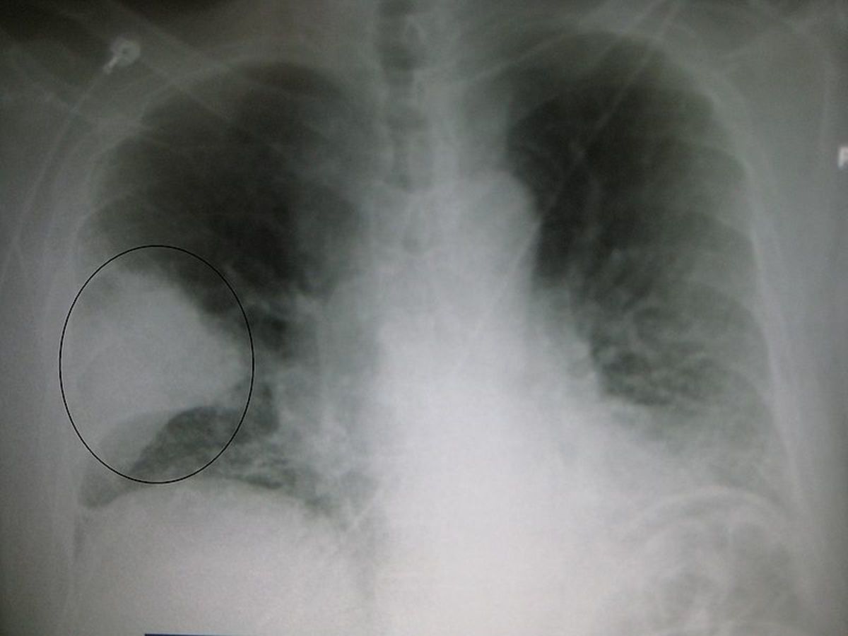 x-ray showing pneumonia