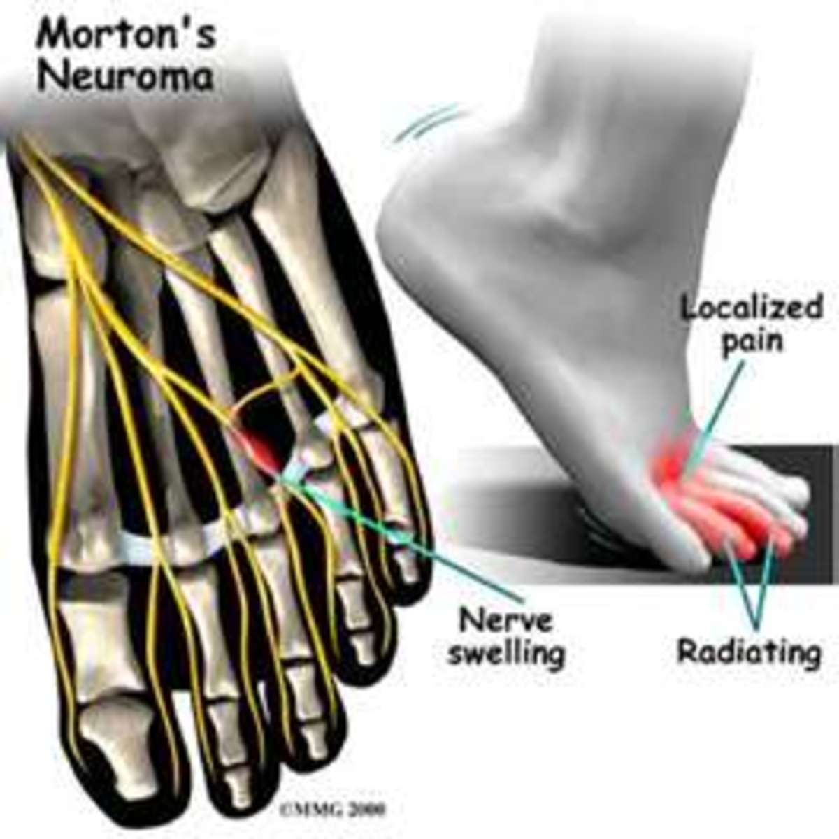Mortons Neuroma - Revised information and natural pain relief.