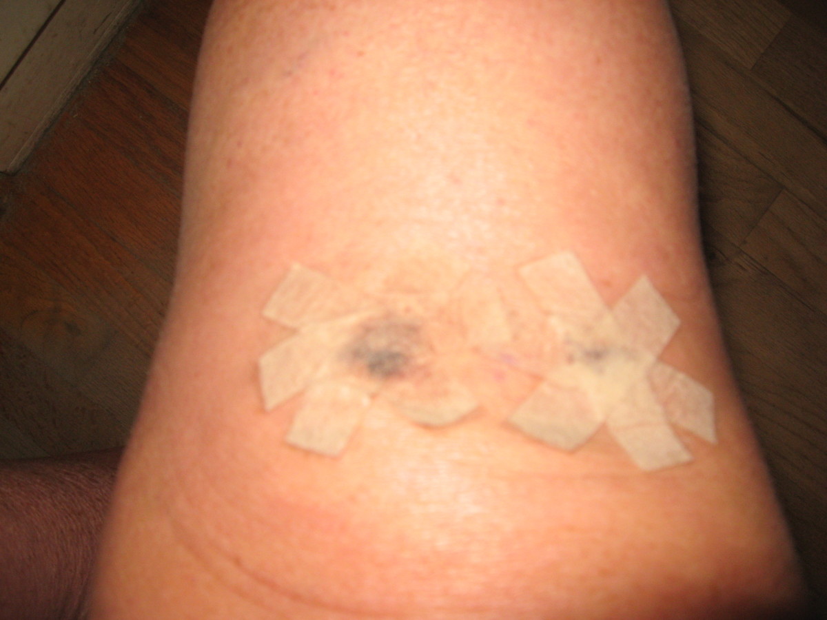 My knee and lower leg were pretty swollen for the first couple of days. My incisions were closed with steri-strips.