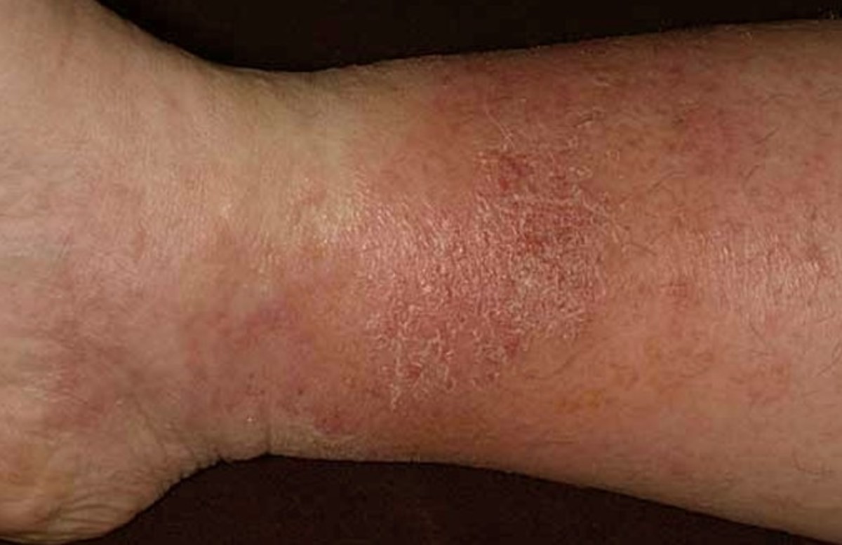 Stasis Dermatitis Causes