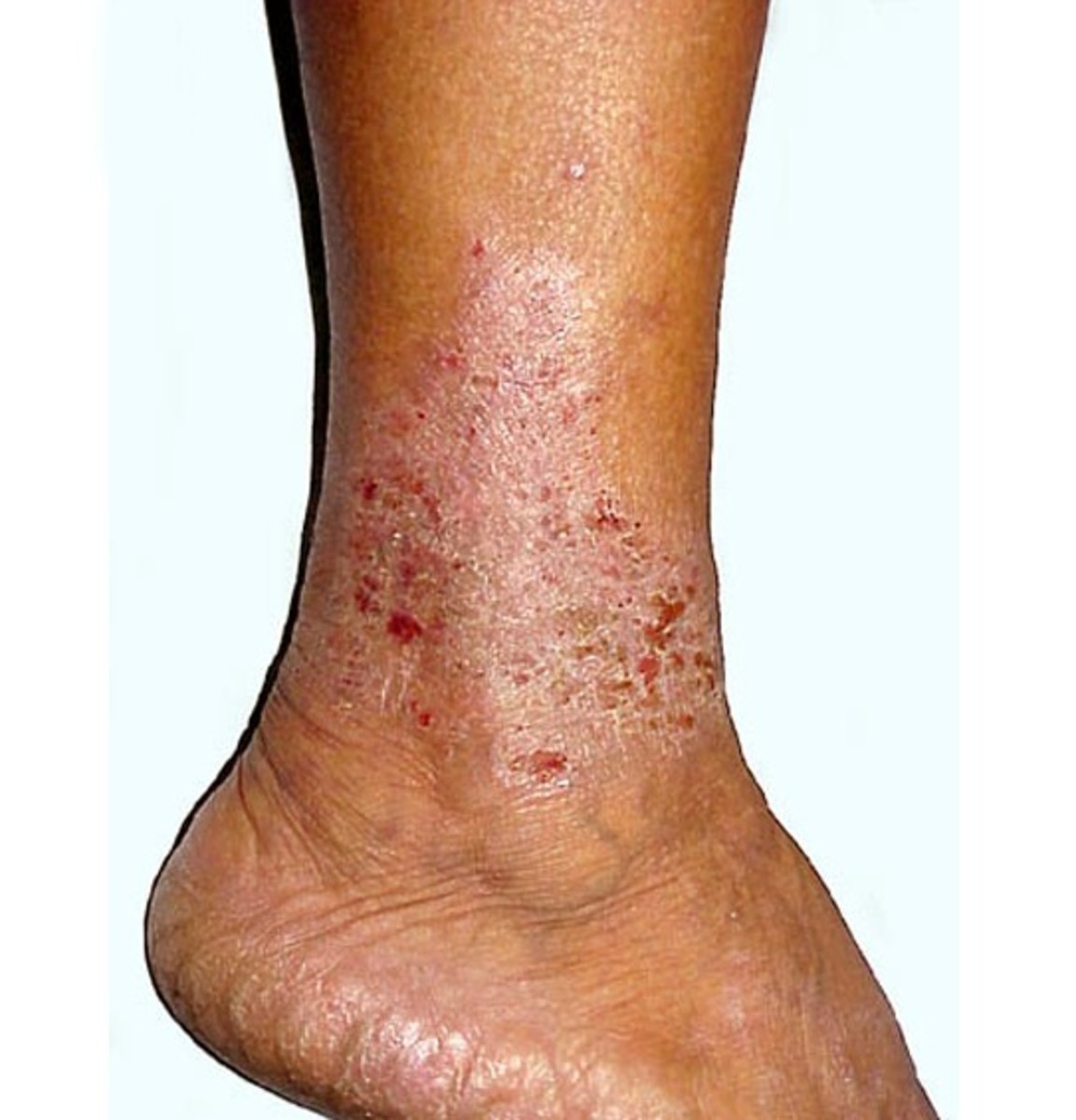 Venous Stasis Dermatitis Treatment OUVYJ