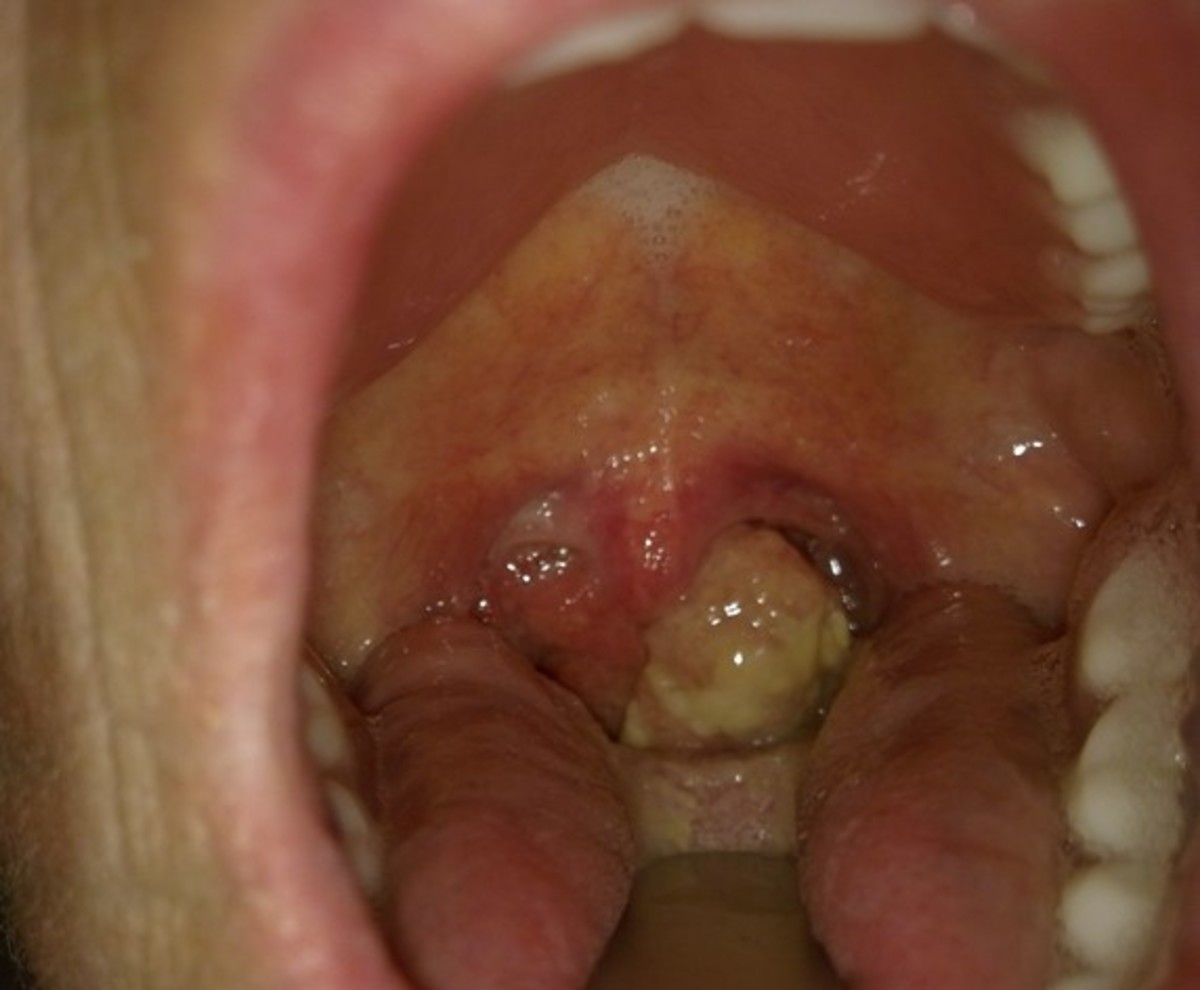 Throat Cancer: Pictures, Survival Rate, Symptoms, Causes, Treatment