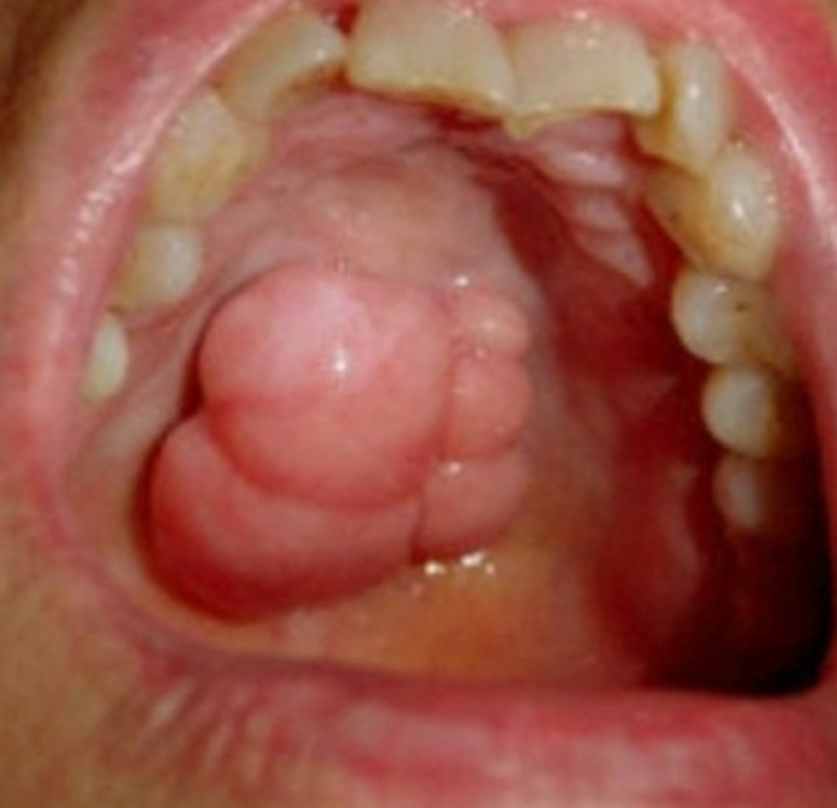 throat-cancer