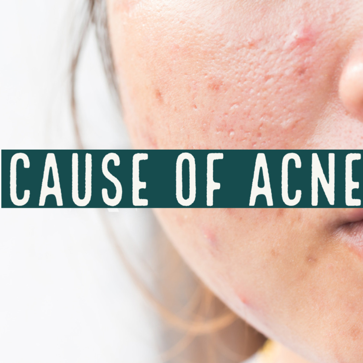 how-to-take-care-of-oily-and-acne-prone-skin