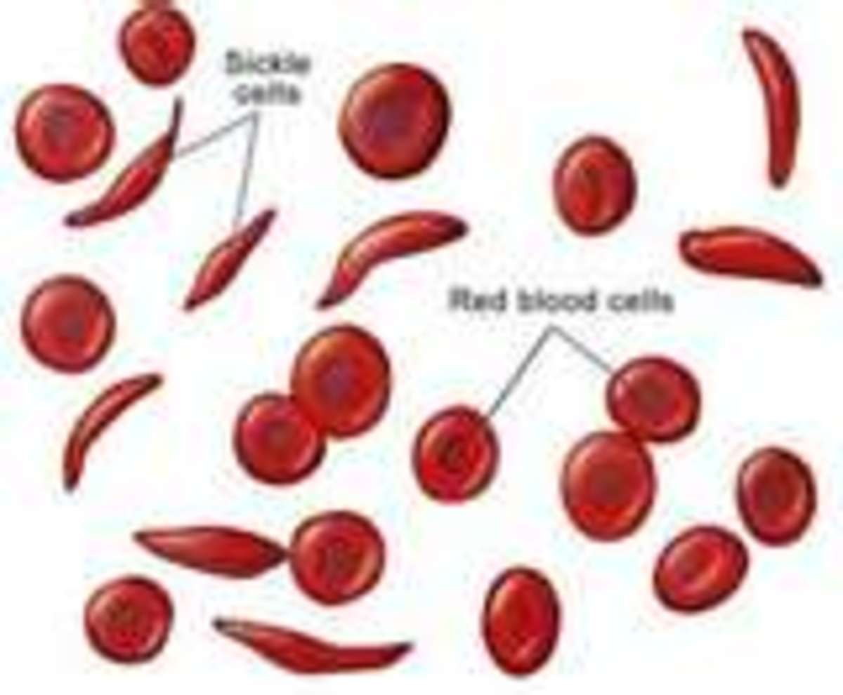 what-is-the-difference-between-sickle-cell-anemia-sickle-cell-disease