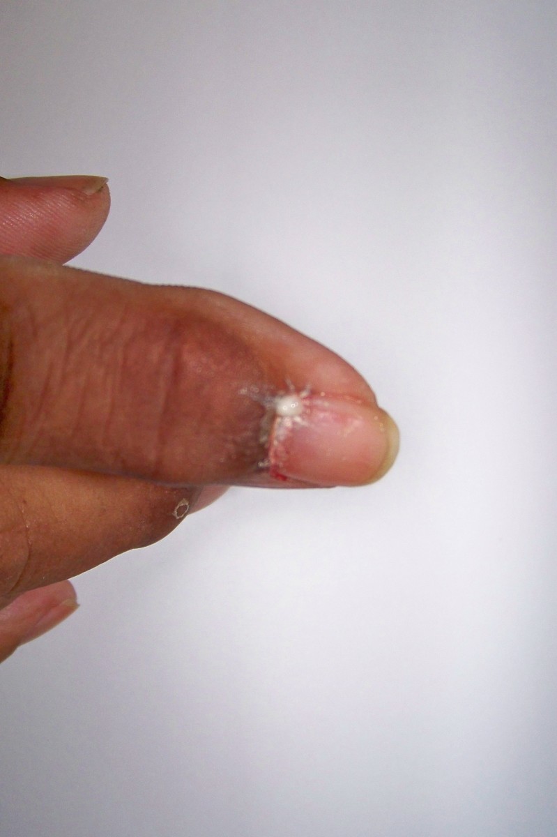 Acute gouty arthritis (Gout) and Kidney cancer surgery complications