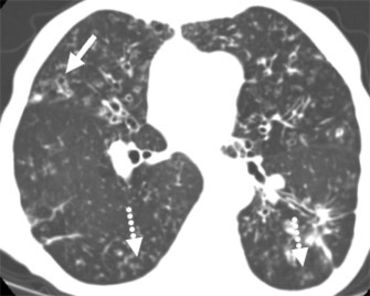 83 year old lady with a chronic cough. CT scan at the level of the pulmonary artery demonstrates bronchiectasis (solid arrow)and tree-in-bud nodules (dashed arrows) involving the middle lobe, lingula and lower lobes, secondary to MAC