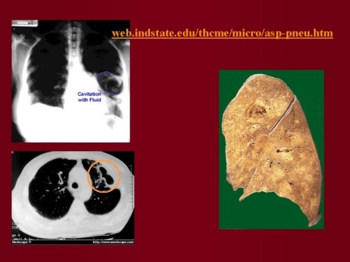 X-ray and CT scan of lungs with abscess. Lung tissue of patient is presented.