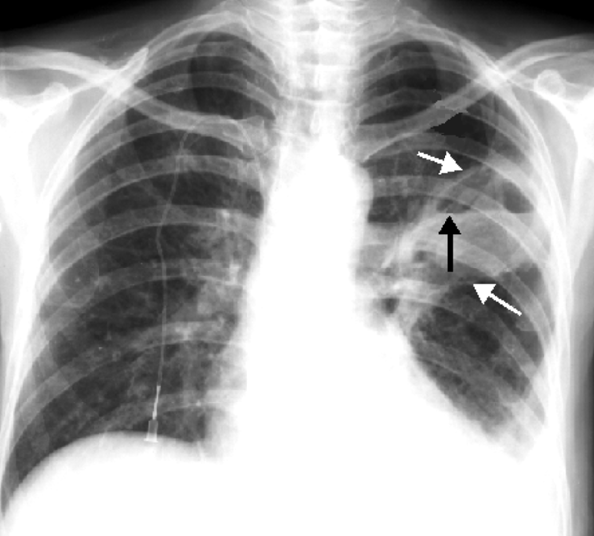 PA chest X-ray examination: A well-defined area of increased transparency can be seen in the left upper lobe (white arrow). More than half of the cavity is filled with fluid and air (black arrow).
