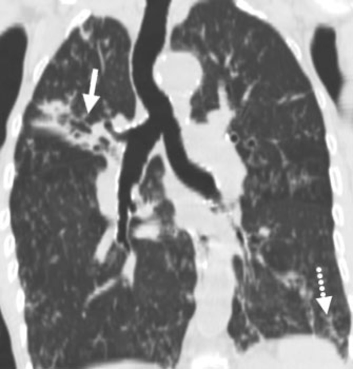 83 year old lady with a chronic cough. Coronal reformat CT scan through the airways demonstrates extensive bronchiectasis, tree-in-bud nodules (dashed arrow) and right upper lobe segmental atelectasis (solid arrow) secondary to MAC
