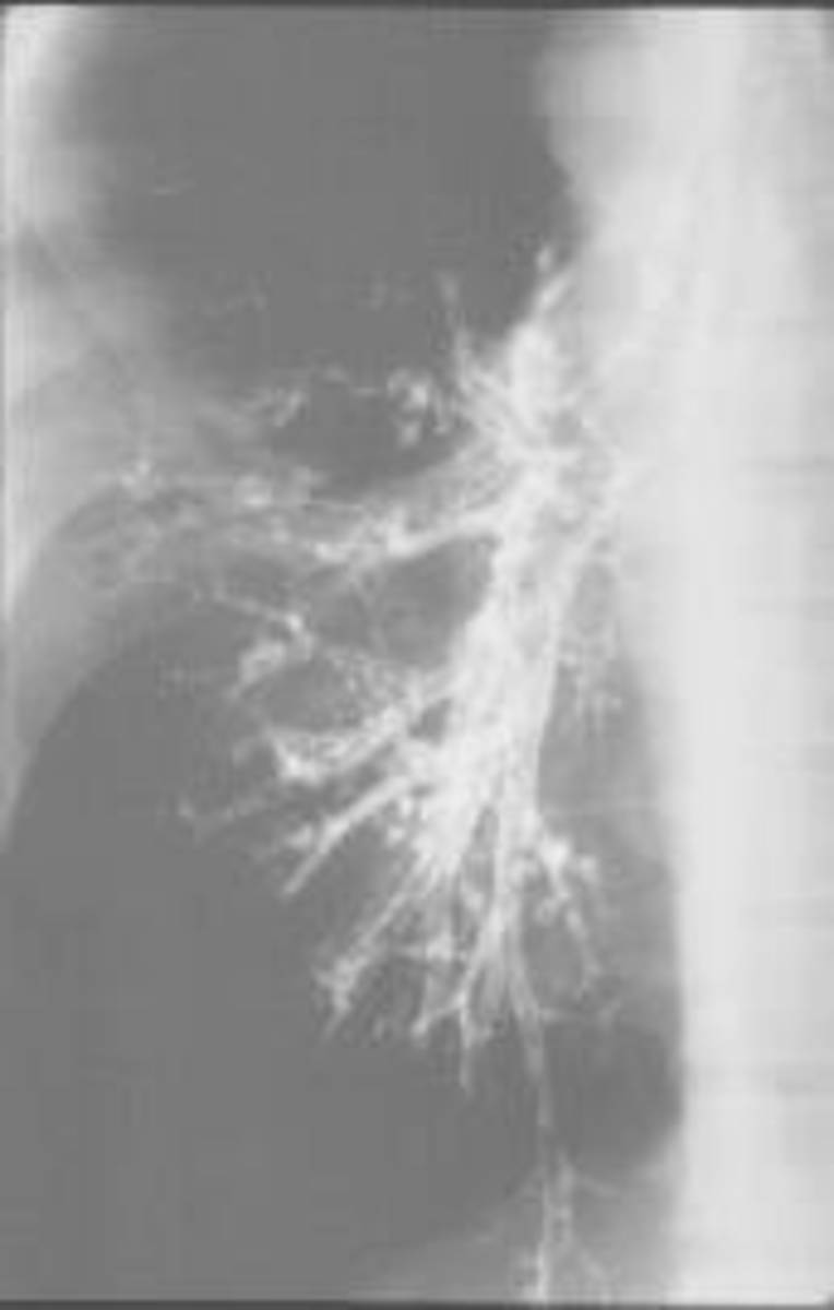 Bronchiectasis Radiograph Endobronchial radiographic dye is used to demonstrate the dilated bronchi in bronchiectasis.