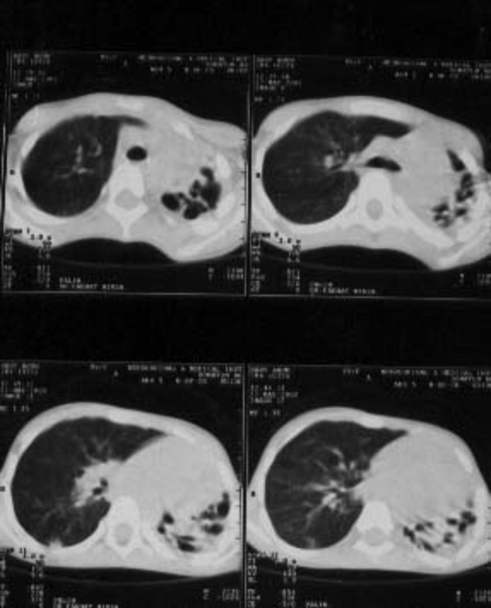 CT scan showing extensive bronchiectasis of left lung.