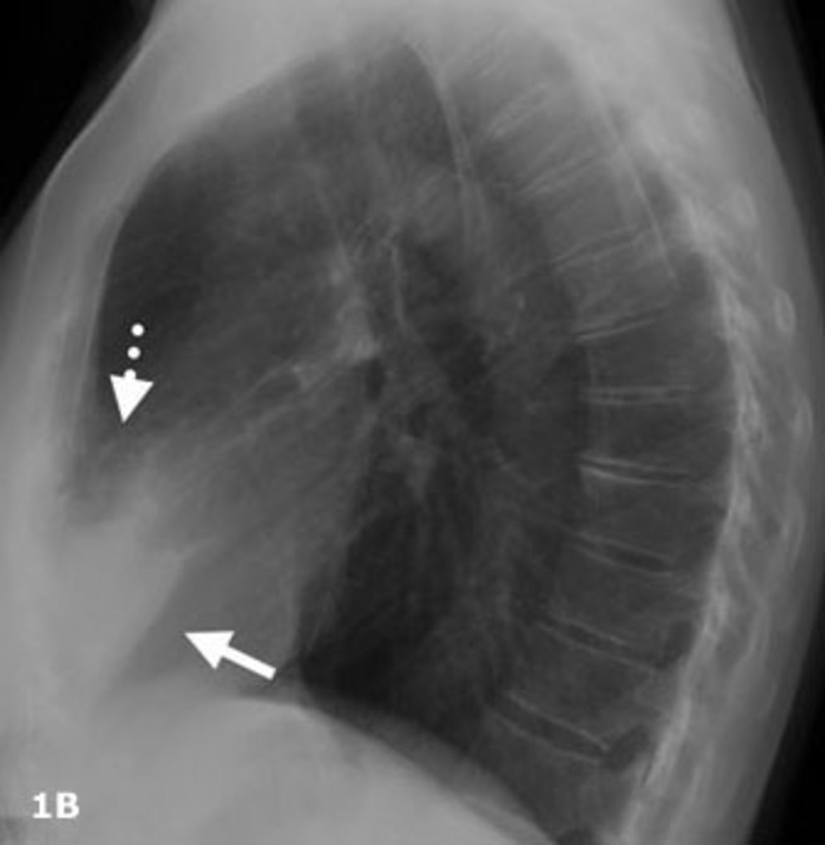 PA (1A) and Lateral chest (1B) radiographs in a 64 year old lady with a chronic cough secondary to MAC. There is air space opacity in the middle lobe (solid arrows) and lingula (dashed arrows)