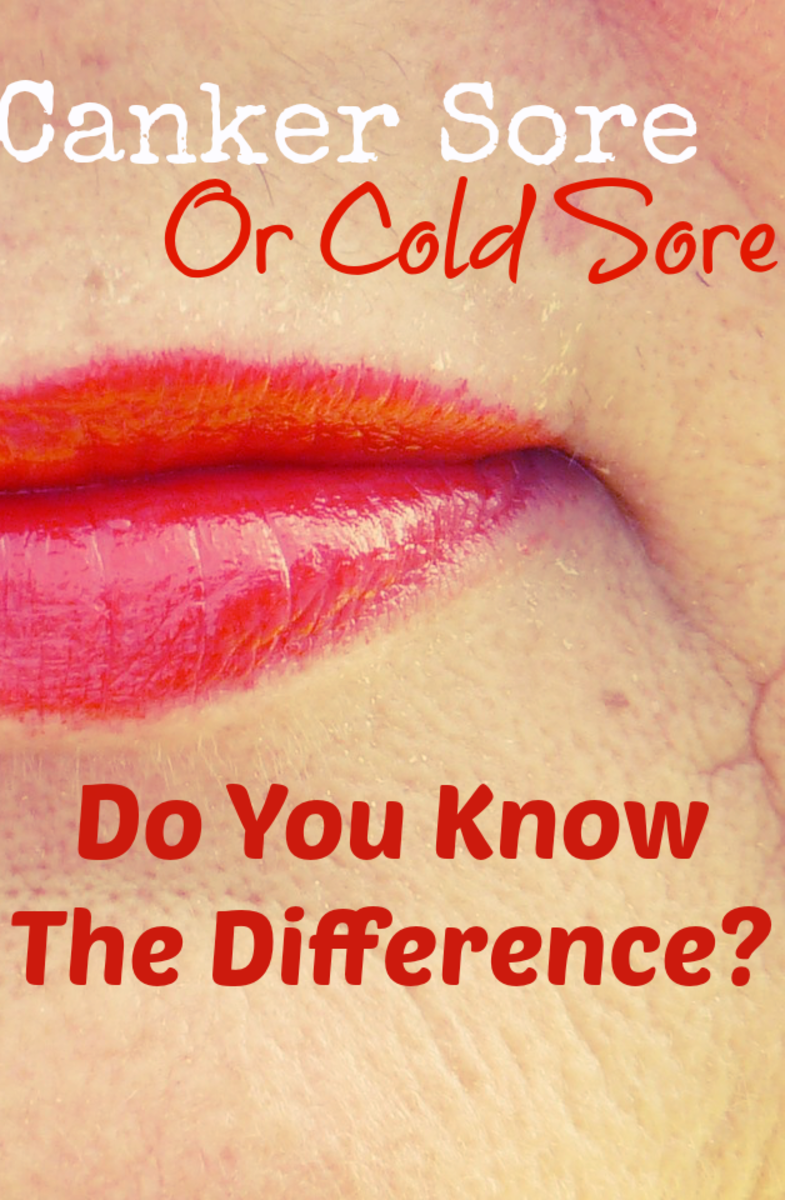 Cold Sore Or Canker Sore? Do you know the difference?