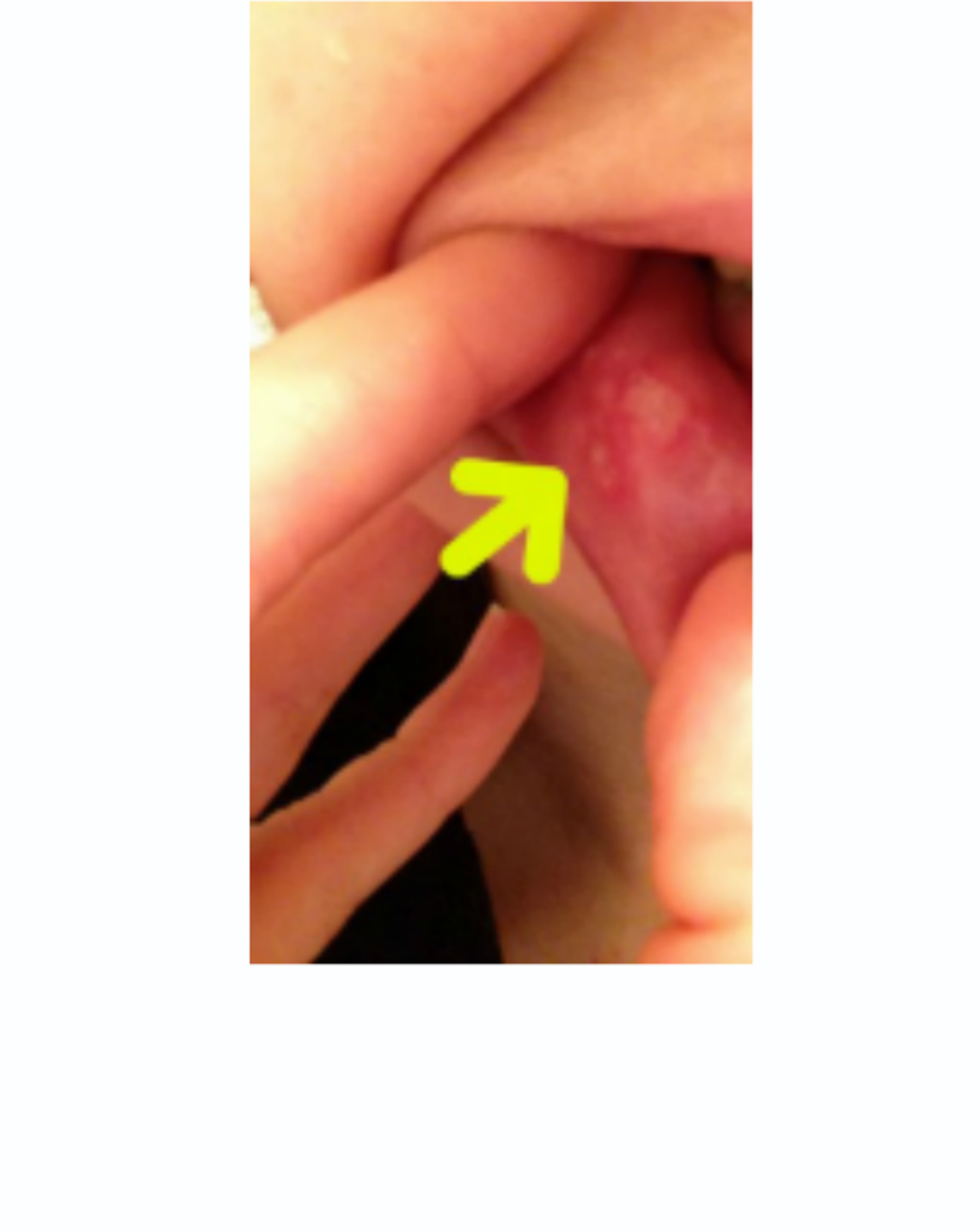 Canker sores can develop on the inside of the lip, on the tongue or in the back of the throat.