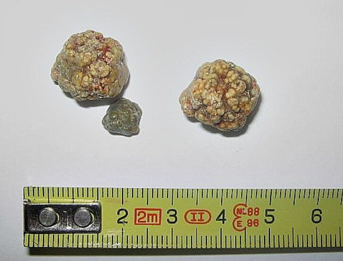 how-to-flush-out-gallstones