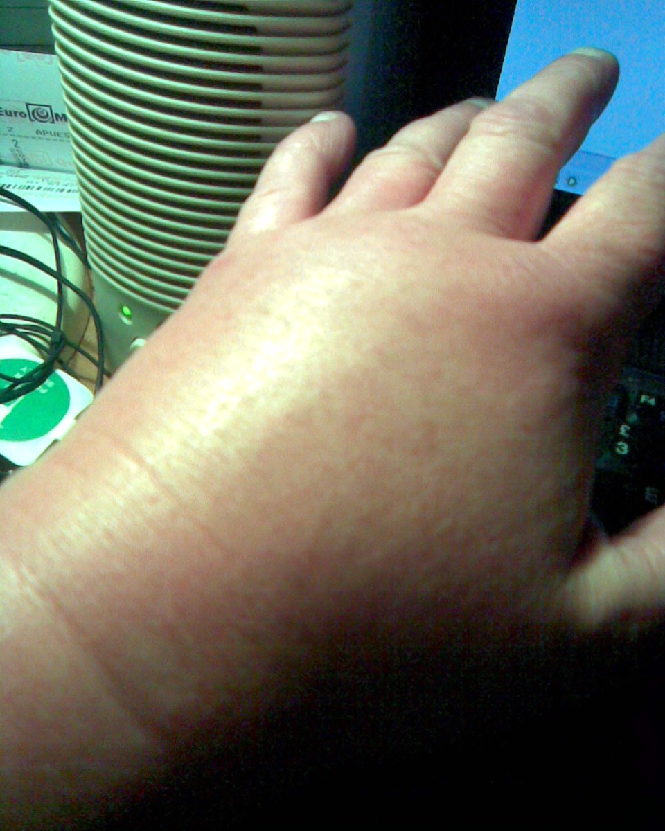 back of hand up like a glove. The bite mark is barely visible.