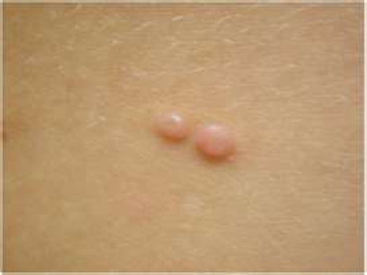 Molluscum Contagiosum  - do you squeeze and pop or not?