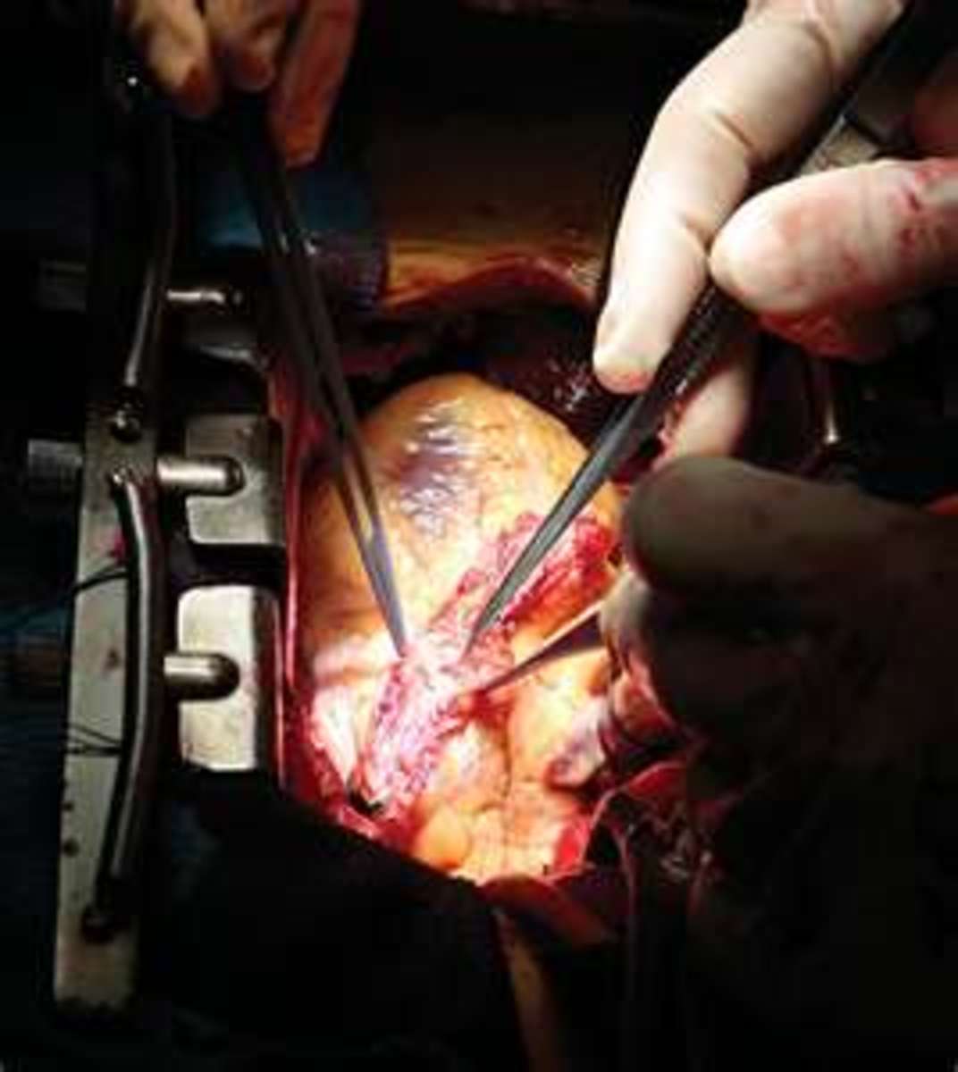 what-to-expect-after-open-heart-surgery