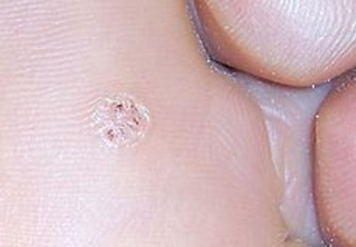 Plantar Warts are often more common on the bottom of the foot, than they are on other sites of the body. However they can develop on the hand as well. Often surgical incision by a Podiatrist is needed to remove these painful skin growths.
