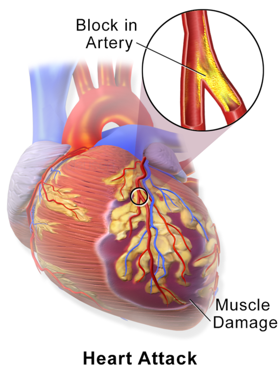 heart-attack-women-and-heart-attack-symptoms